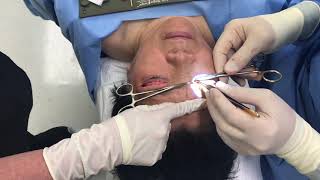 Upper Blepharoplasty amp Brow Lift Procedure [upl. by Rothstein]