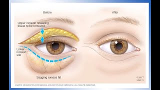 Dr Kristina Tansavatdi  Blepharoplasty PostOperative Instructions [upl. by Naloc]