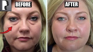 Blepharoplasty Review amp Testimonial [upl. by Virge]