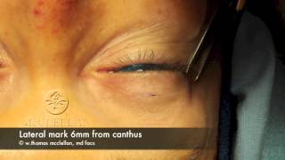 Upper Eyelid Surgery Blepharoplasty  One Week Post Op  Before amp After [upl. by Argile]