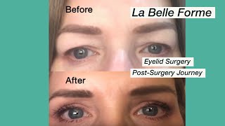 Tutorial  Marking the Upper Lid Blepharoplasty [upl. by Nudd]